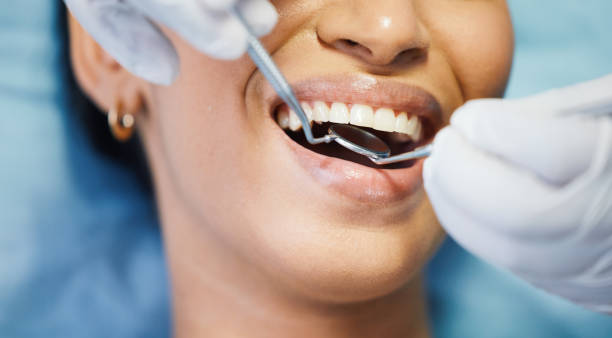 Best Knocked-Out Tooth (Avulsed Tooth) Treatment in USA